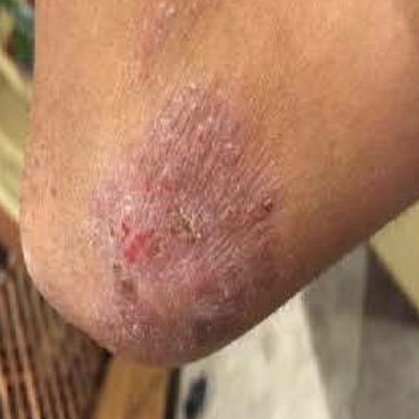 湯の花使用9日目