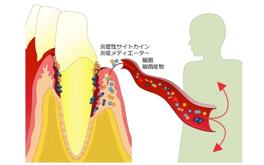 図7 歯周病（歯肉炎・歯周炎）と全身の関係：山崎 和久、 2016（参考文献4）の図3から引用。