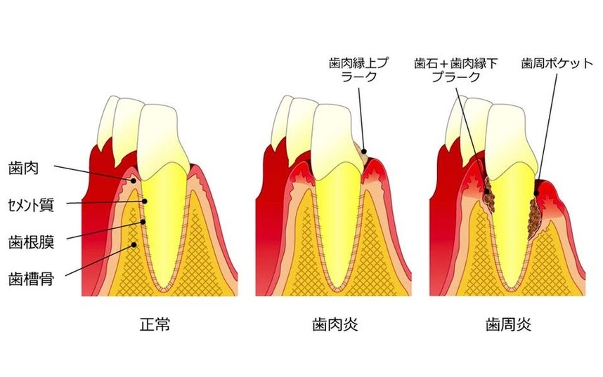 図8 歯周病の発症機序：山崎 和久、 2016（参考文献4）の図1から引用。